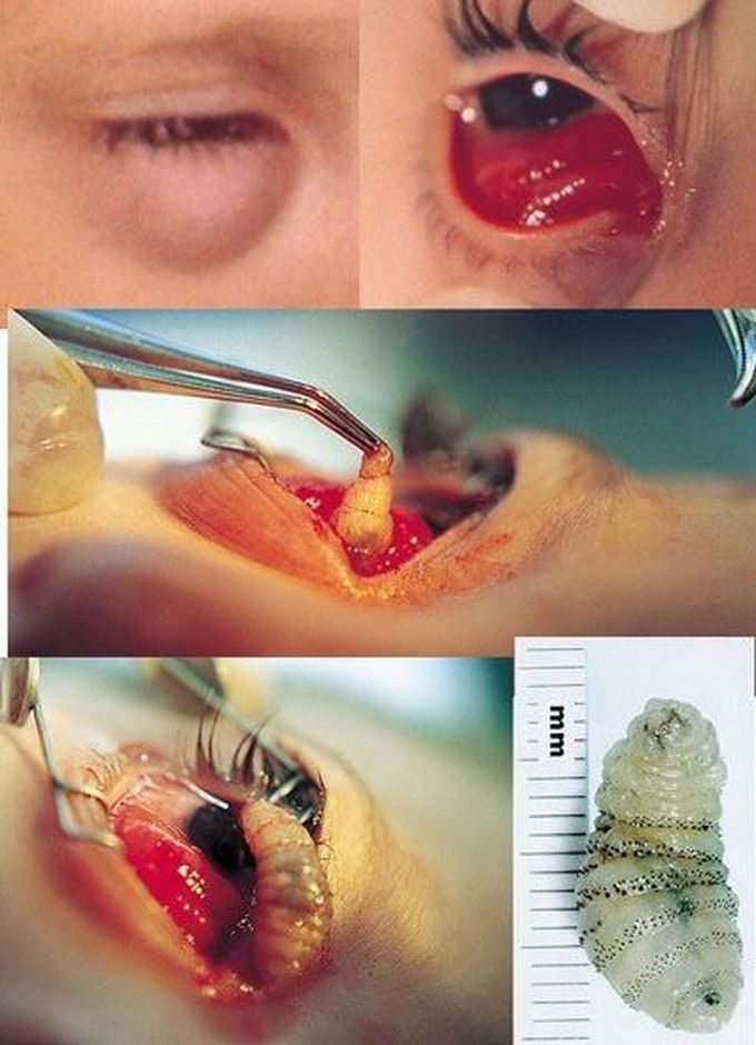 Eye parasite