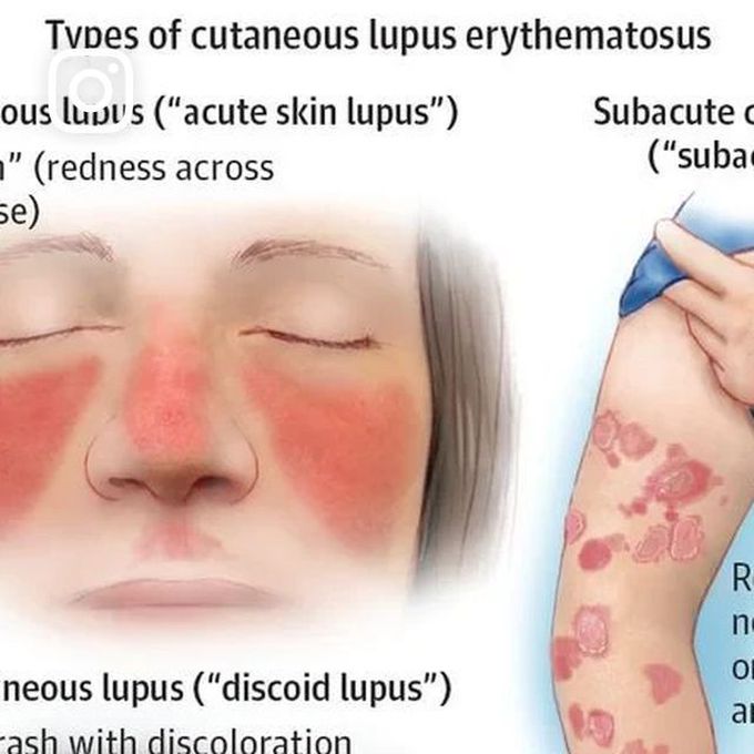 Erythema