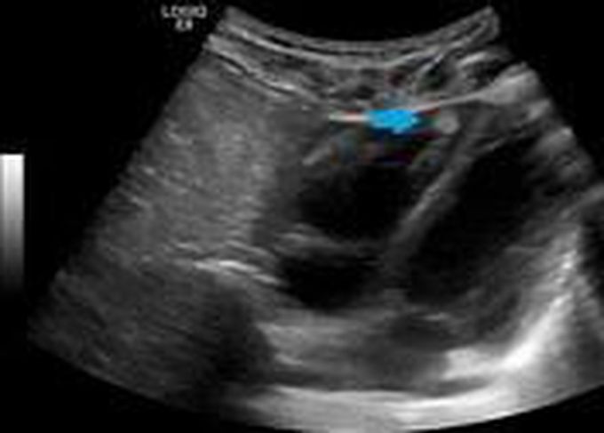 Rhabdomyoma symptoms