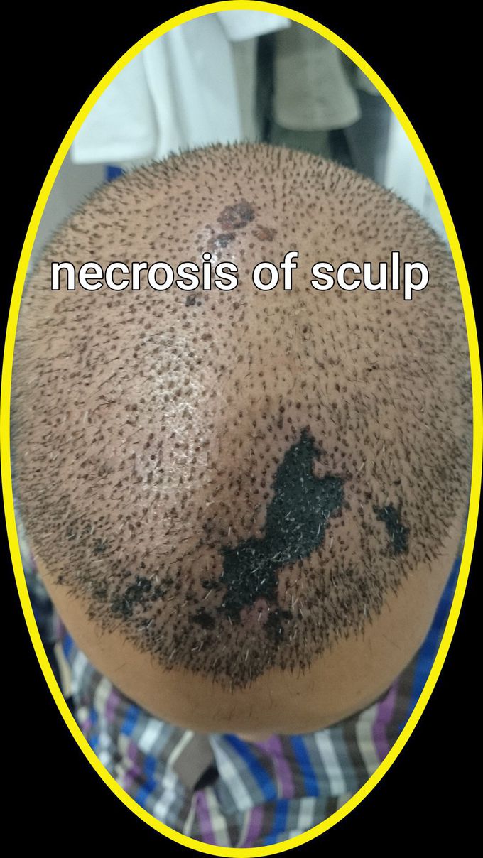 Sculp necrosis