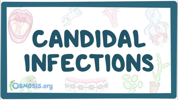 Candidal infections - causes, symptoms, diagnosis, treatment, pathology