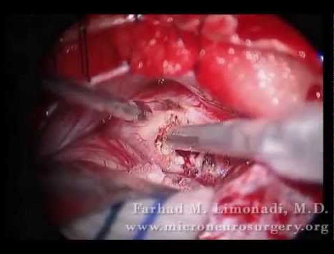 Vestibular Schwannoma (Acoustic Neuroma) Neurosurgical Removal (brain surgery)