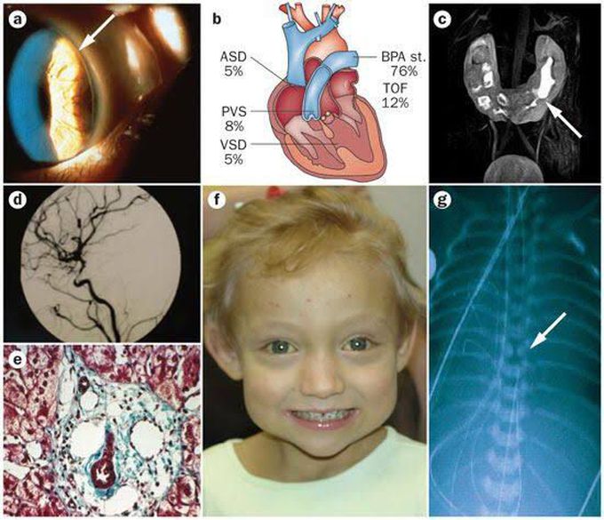 Allagile syndrome pneumonics (6p)