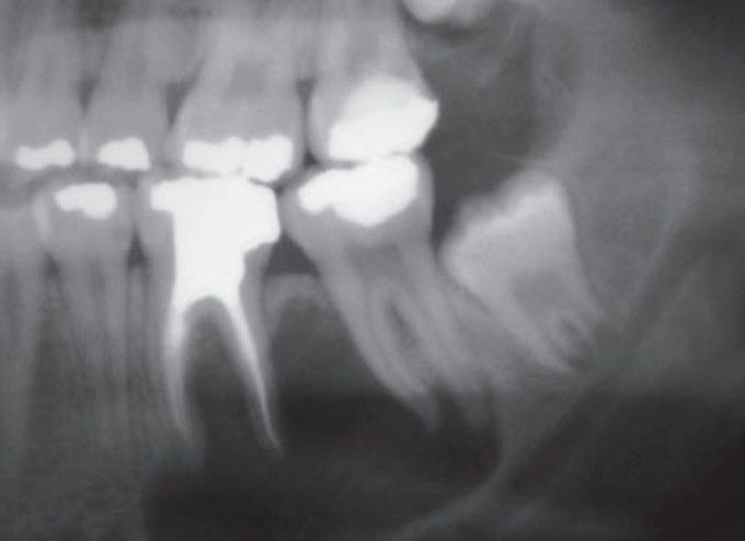 Periapical cyst bitewing x ray