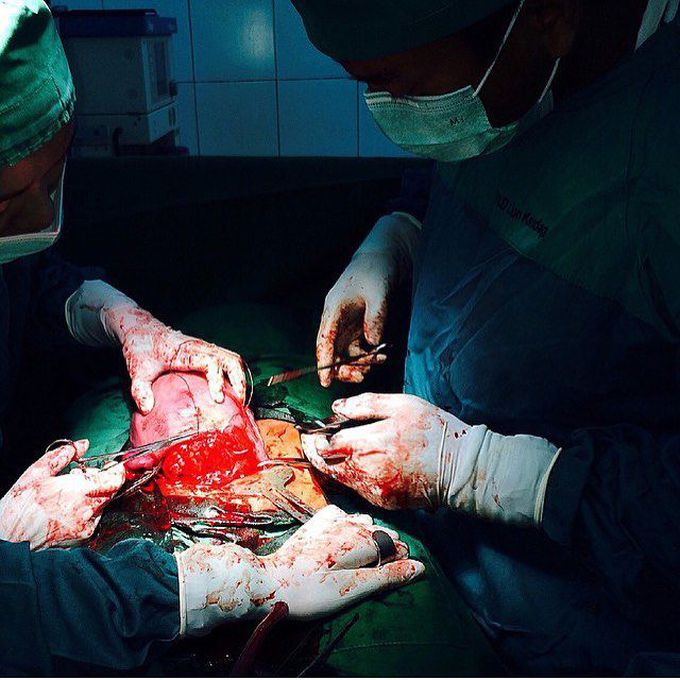 General surgeon doing Cesarean Section (C-Section)