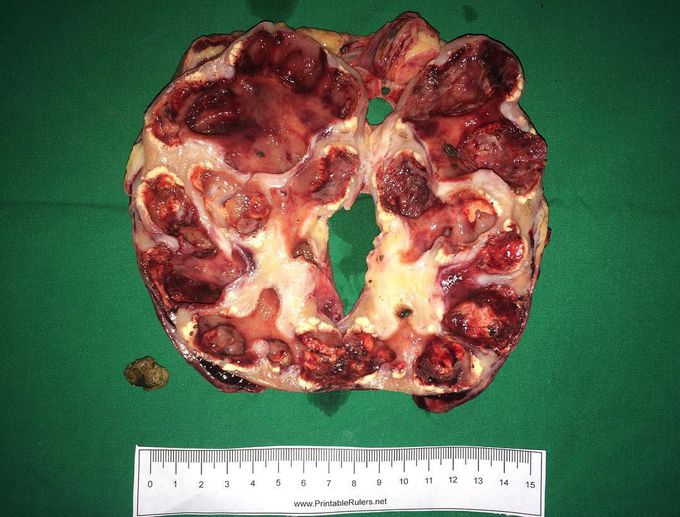 Hydronephrosis