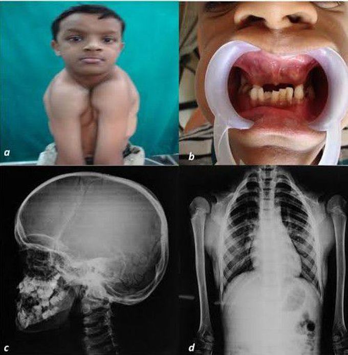 Cleidocranial dysplasia