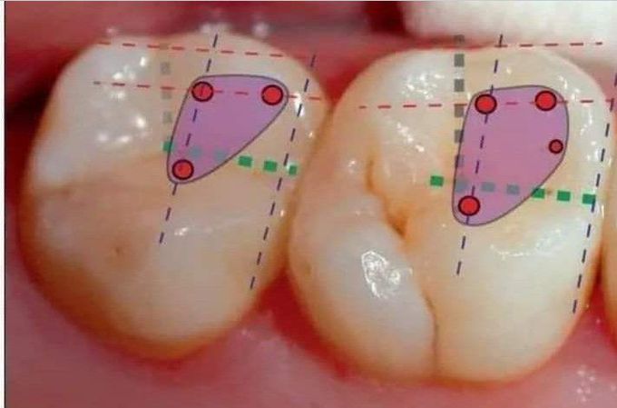 Canal orifices