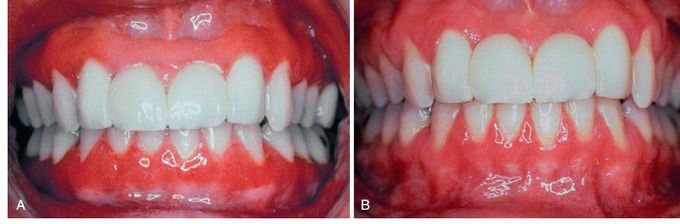 Plasma Cell Gingivitis.