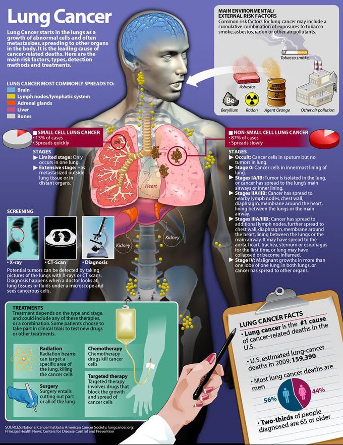 Lung cancer