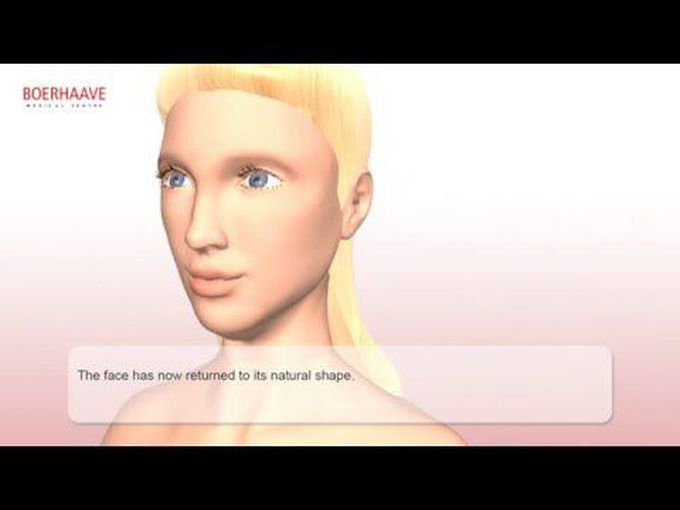 Facelift Procedure- Animation
