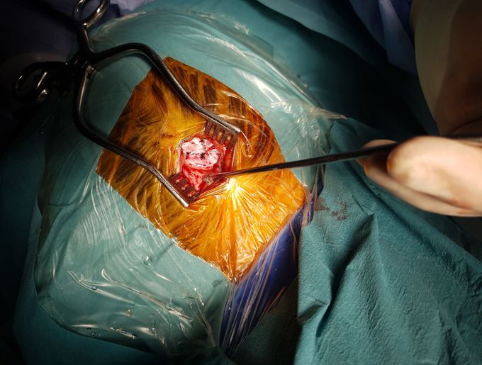 Neurosurgery