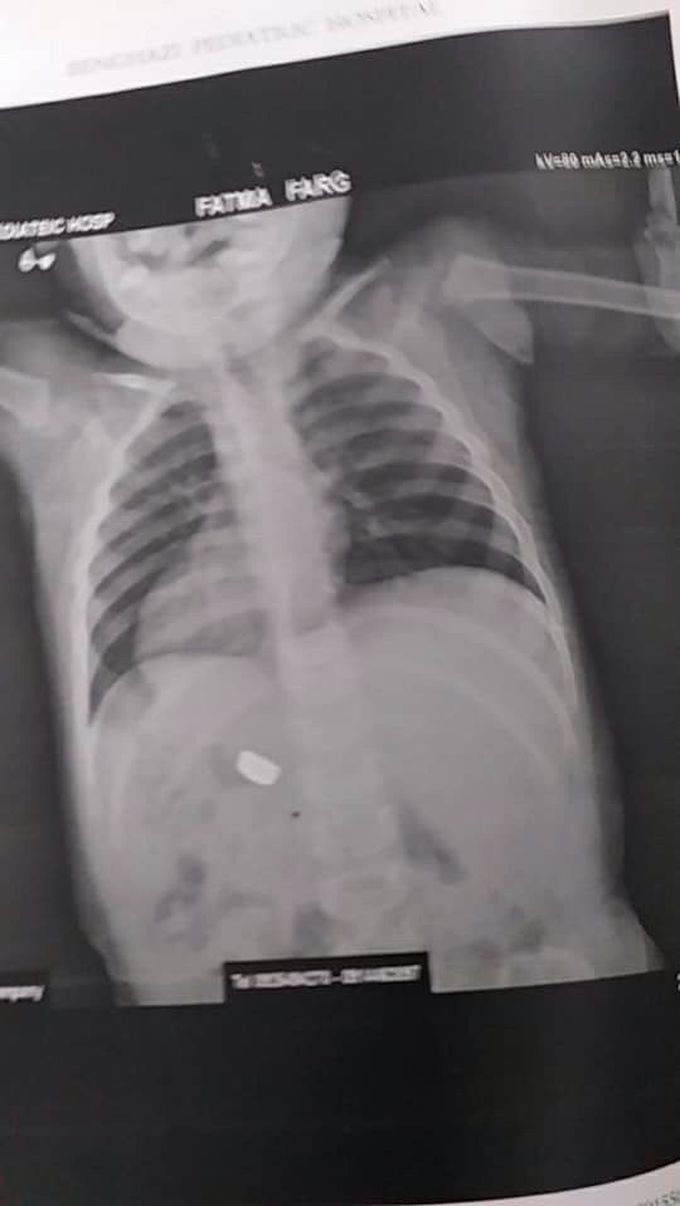 Girl swallowed
