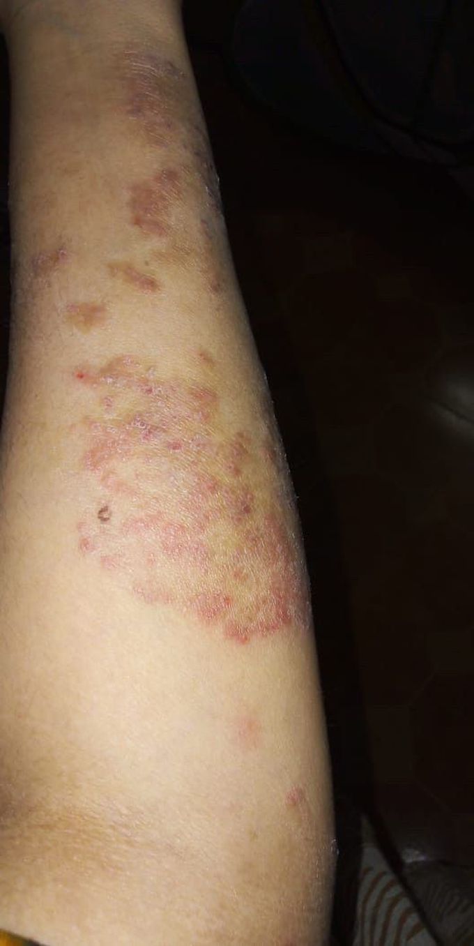 Dermatology