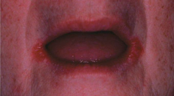 Actinic cheilitis