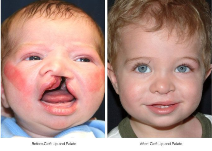 Cleft lip and cleft palate