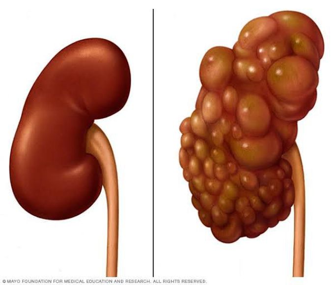 kidney disease