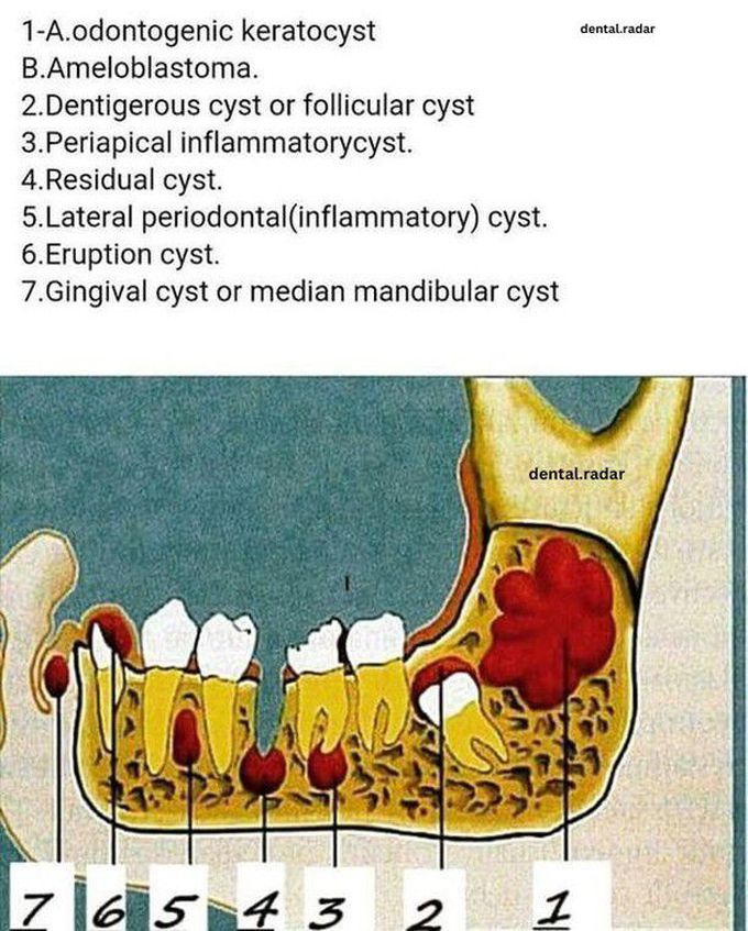 Locations of different cysts in oral cavity