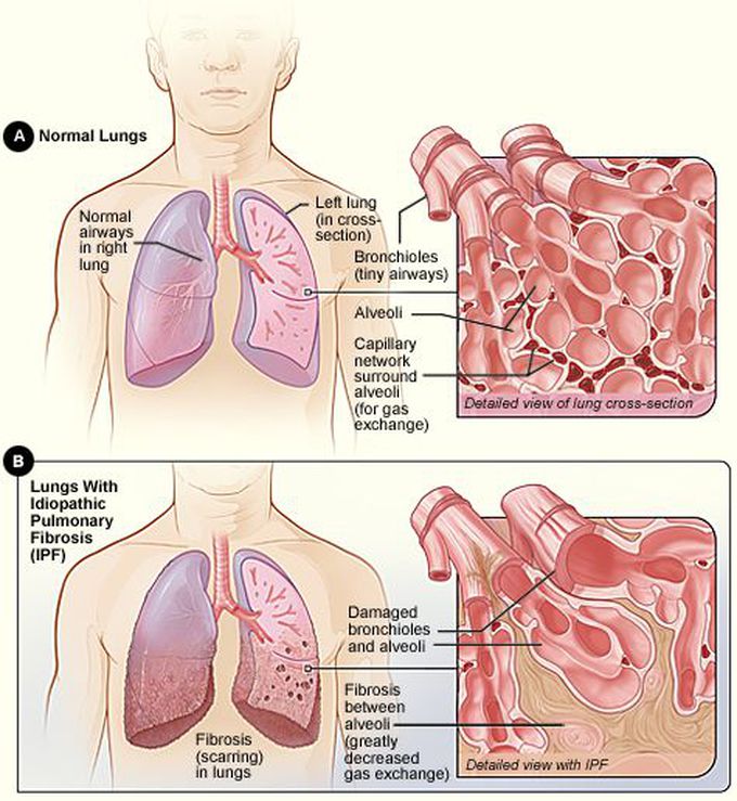 Complications of pulmonary fibrosis