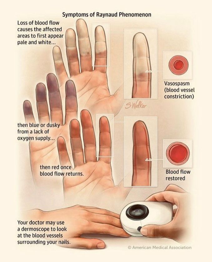 Raynaud's phenomenon