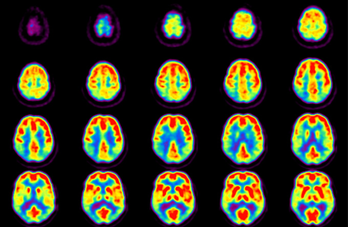 What Can A Pet Scan Diagnose In The Brain