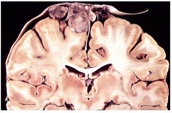 Meningioma