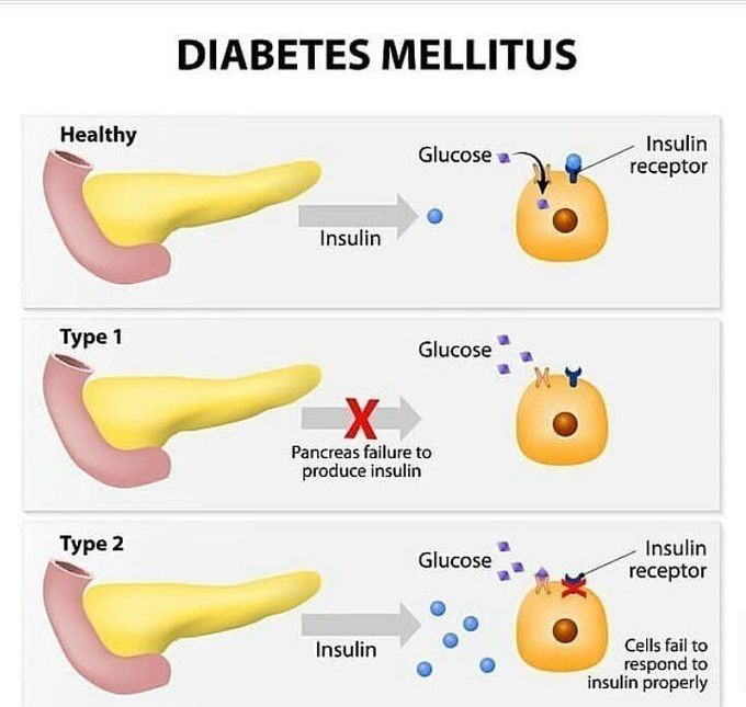 Diabetes types