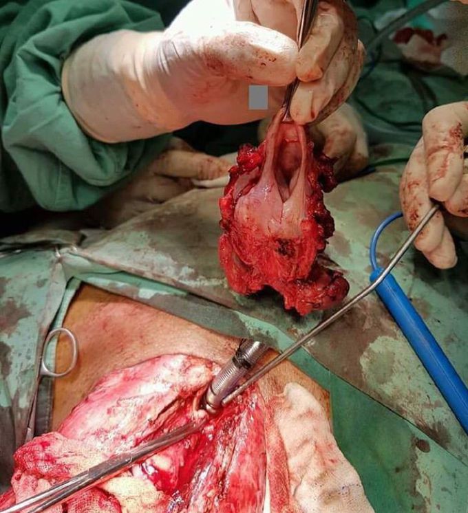 Laryngectomy 🔪