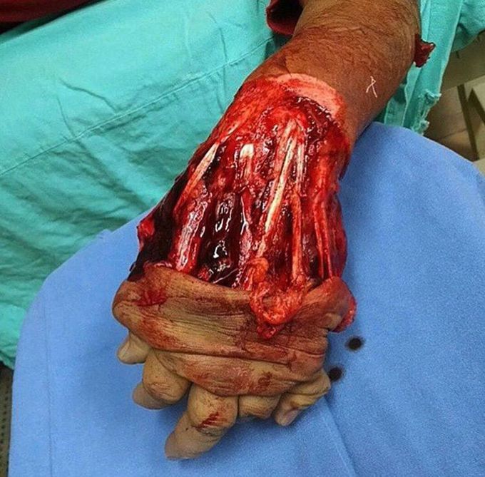 Degloving Injury