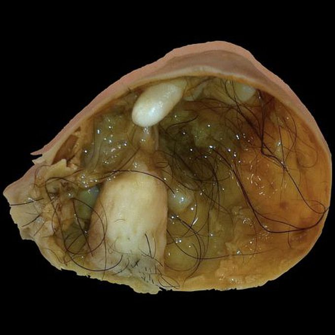 Mature Cystic Ovarian Teratoma