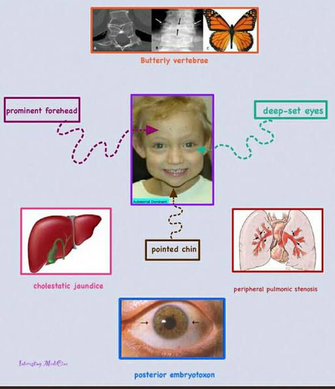 Symptoms of allagile syndrome