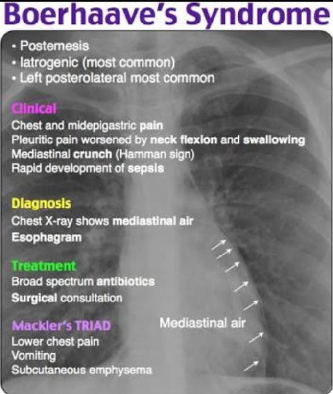 Boerhaave syndrome