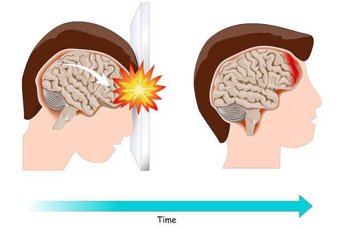 Causes Of Cerebral Contusion MEDizzy