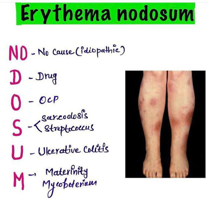 Erythema Nodosum