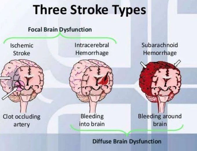 Stroke Types - MEDizzy