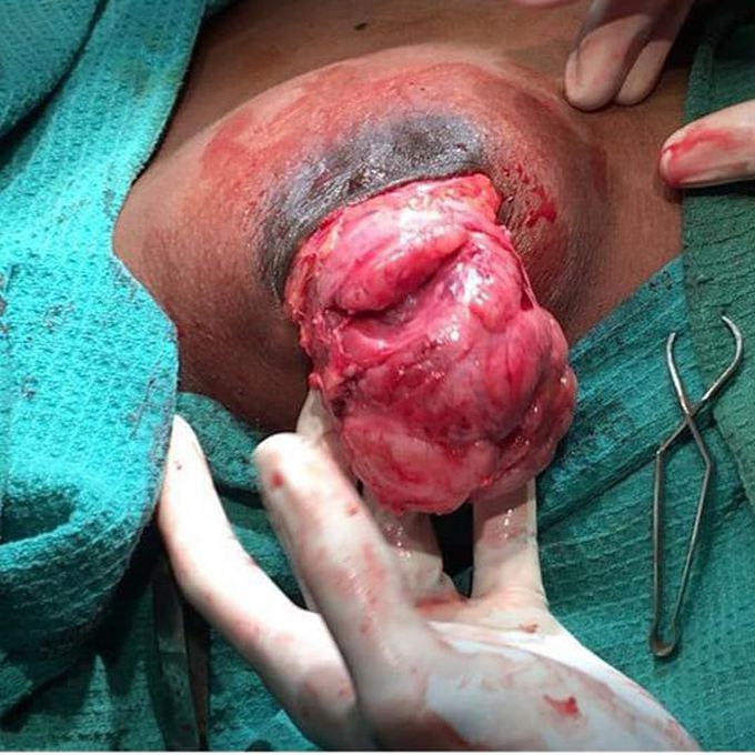 Gaint fibroadenoma breast cancer.