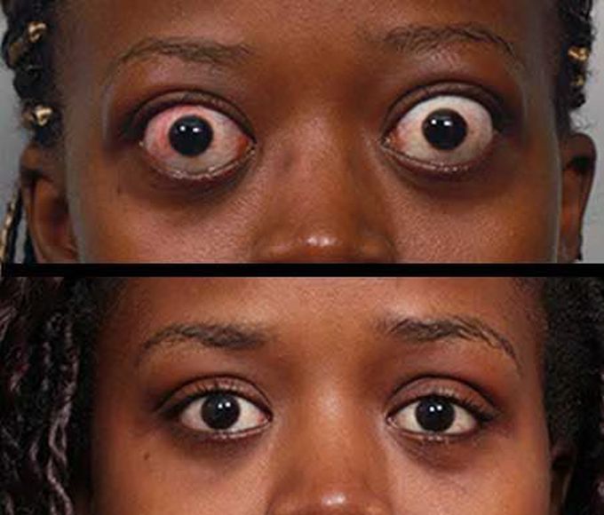 Basedow ophthalmopathy