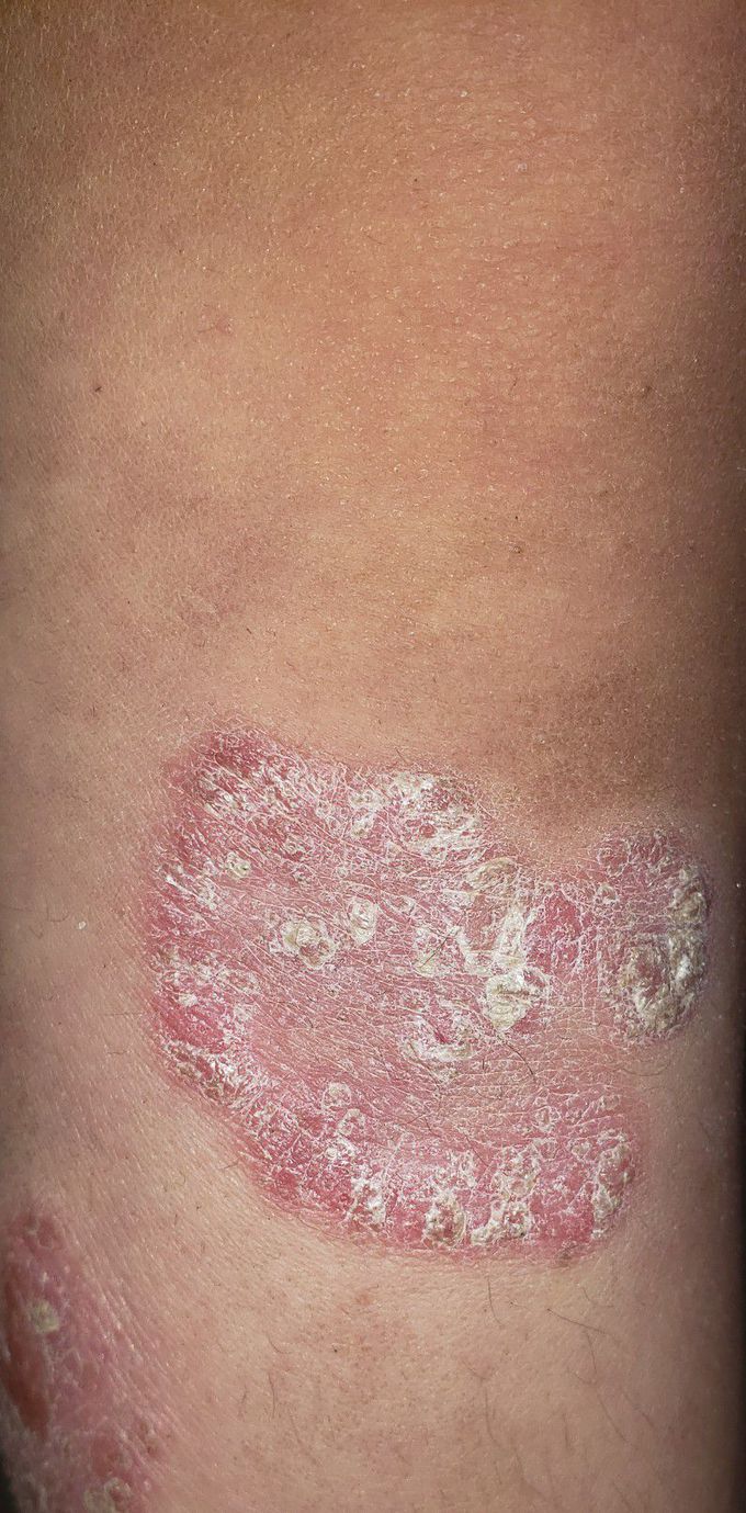 Psoriasis