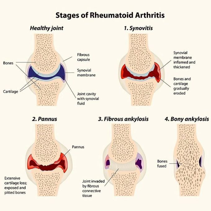 Stages of RA