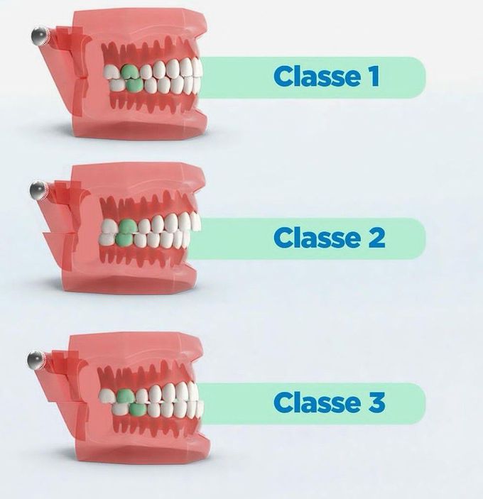 Angles Classification Of Malocclusion - MEDizzy