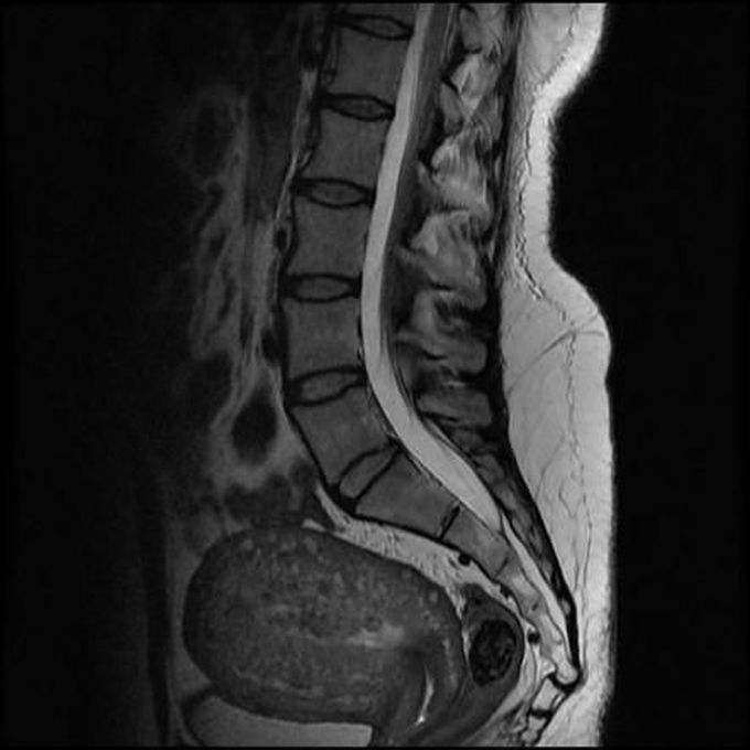 Causes of Coccydynia