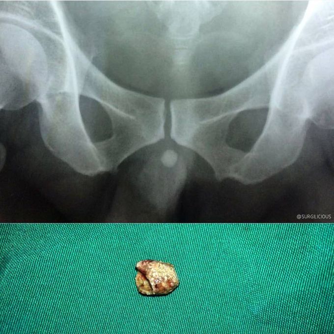 Urinary stone impaction on distal urethra