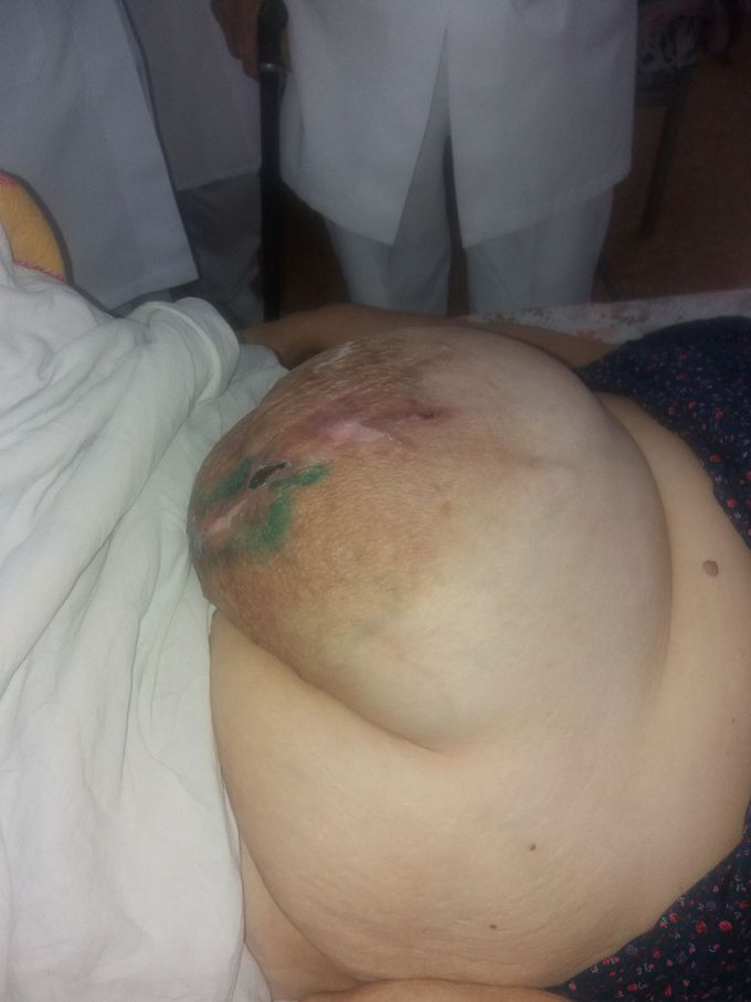 The big hernia