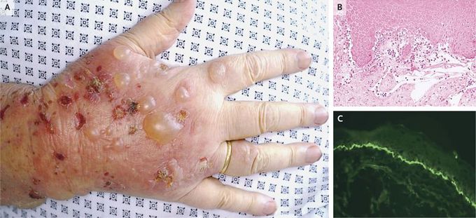 Bullous Pemphigoid