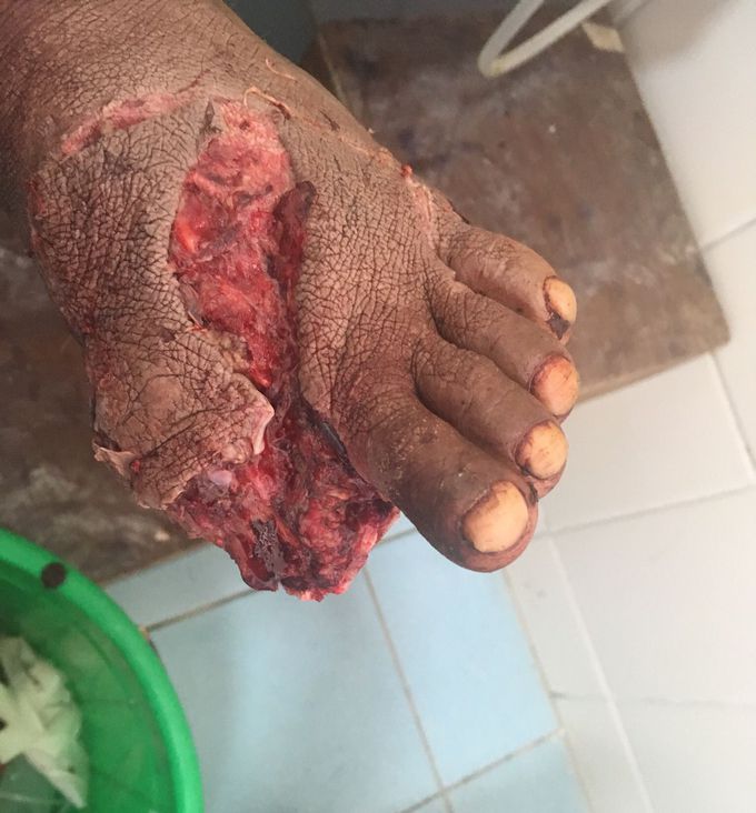 Lacerated wound by tree