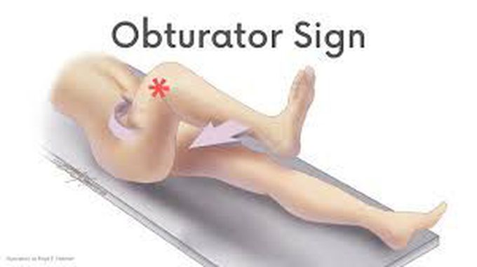 Obturator sign