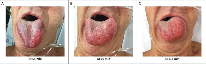 Angioedema after t-PA Infusion