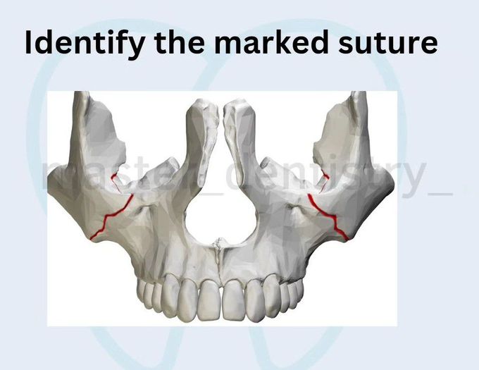 Identify the marked Sutures