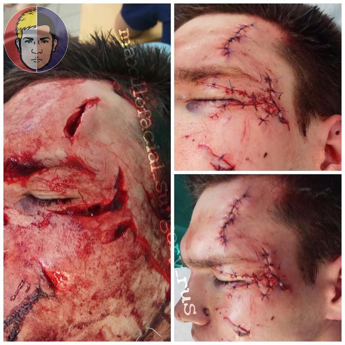 Wounds of the face