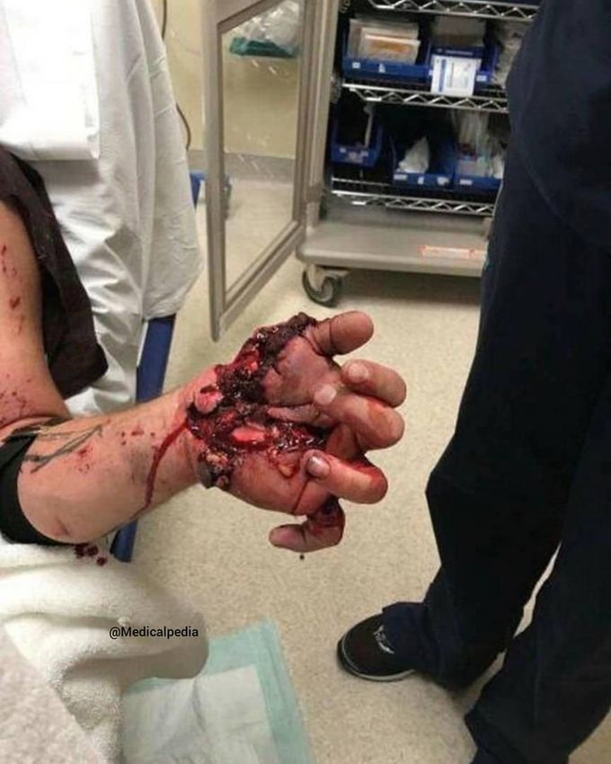 Artillery shell firework accident